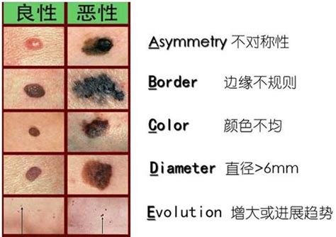 接合痣|如何分辨好壞痣？有「這5大變化」別拖...變黑色素瘤。